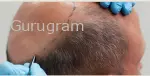 Hair Transplant Near DLF Phase Area, Gurgaon